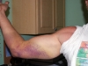 arm-bruise-01